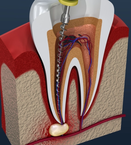 Dantah Clinic offers quick, painless relief for toothaches with root canal treatment by the experienced dentists in Nashik.